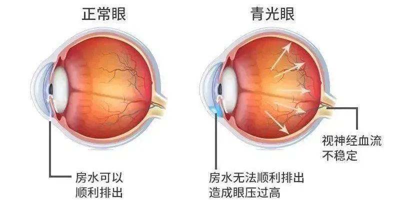 注意！这种致盲性眼病，必须了解插图