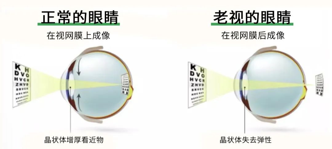 注意！千万别把白内障误当作老花眼！插图(1)