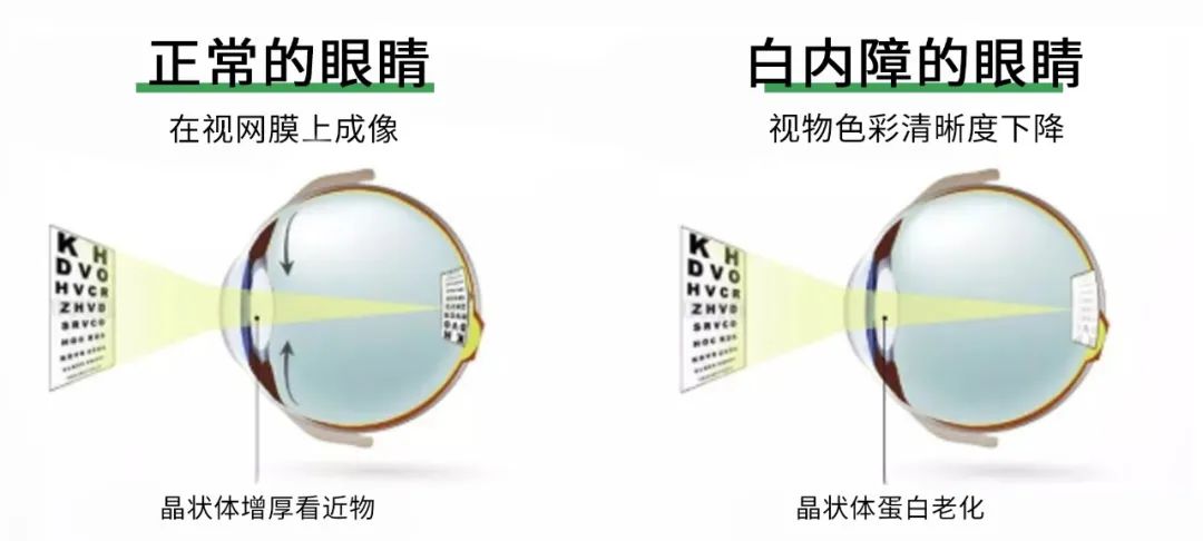 注意！千万别把白内障误当作老花眼！插图(2)