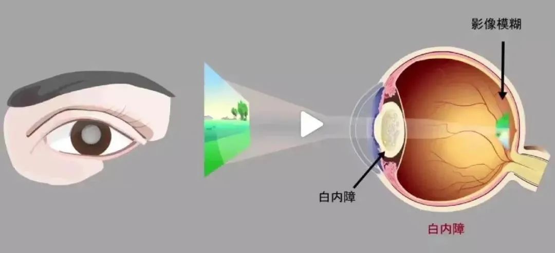 晶状体浑浊有办法恢复透明吗？插图(1)