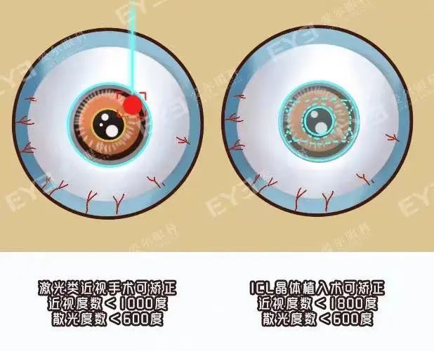 @运动达人，近视手术后能否运动，请牢记这3点！插图