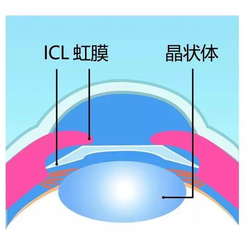 近视手术的“天花板”ICL晶体植入全攻略，看这一篇就够了~插图(1)