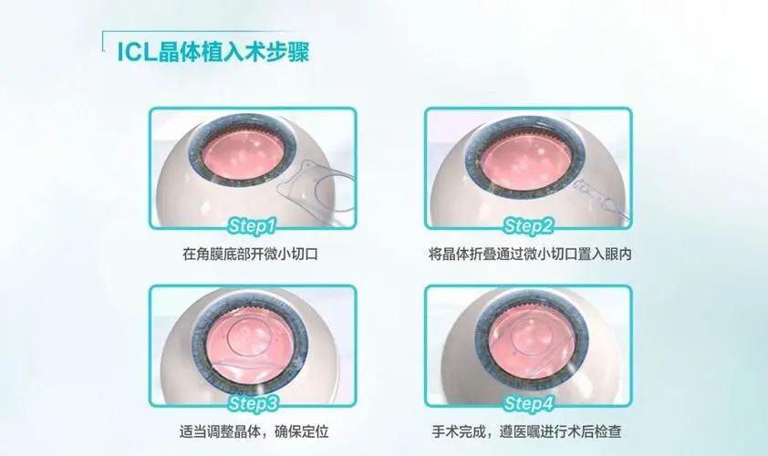 近视手术的“天花板”ICL晶体植入全攻略，看这一篇就够了~插图(2)