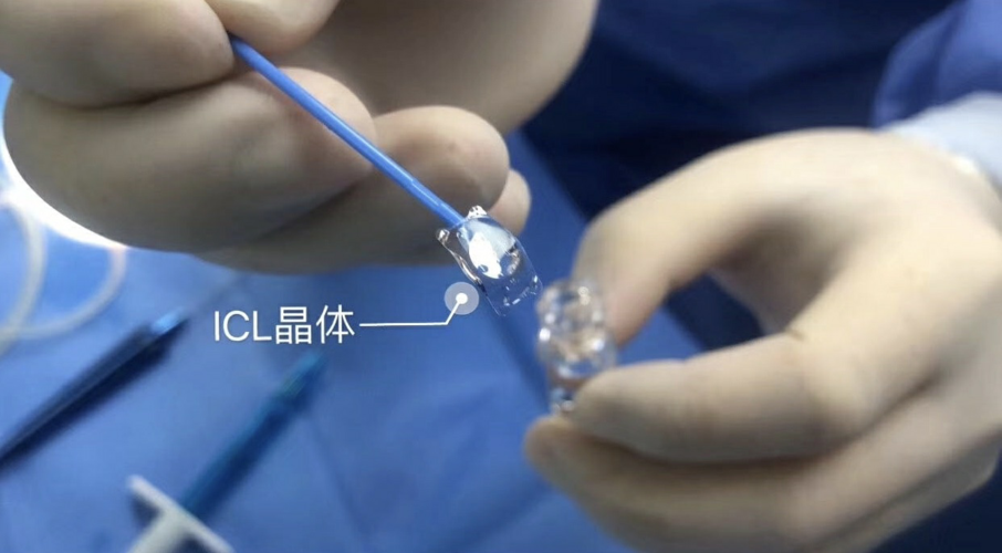 近视手术的“天花板”ICL晶体植入全攻略，看这一篇就够了~插图(3)
