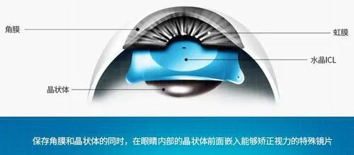 近视手术的“天花板”ICL晶体植入全攻略，看这一篇就够了~插图(4)