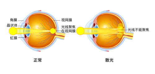 近视手术的“天花板”ICL晶体植入全攻略，看这一篇就够了~插图(7)