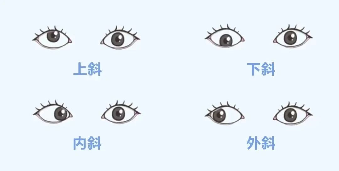 关于孩子斜视的九大常见疑问，家长们都应该了解，建议收藏！插图