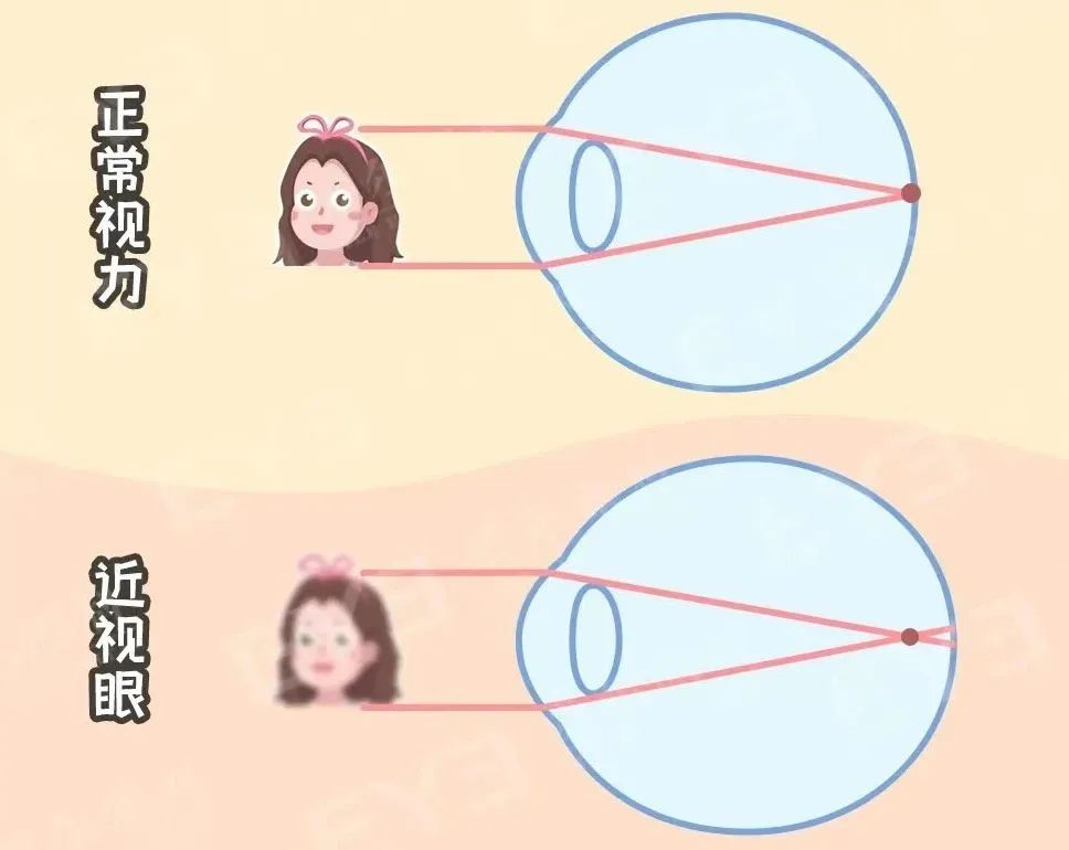 做近视手术，视力恢复到1.0还是1.5？插图(1)