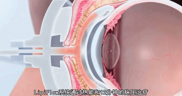 LipiFlow热脉动治疗——干眼治疗先端技术,解救你的双眼!插图(1) LipiFlow热脉动治疗——干眼治疗先端技术,解救你的双眼!插图(1)