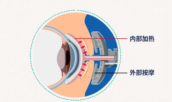 LipiFlow热脉动治疗——干眼治疗先端技术，解救你的双眼！插图(2)