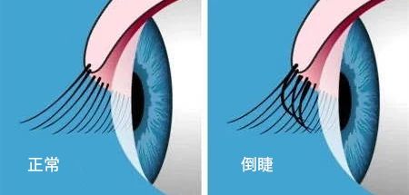 警惕 | 不要小瞧了眼睛分泌物，它可以辨别多种眼病插图
