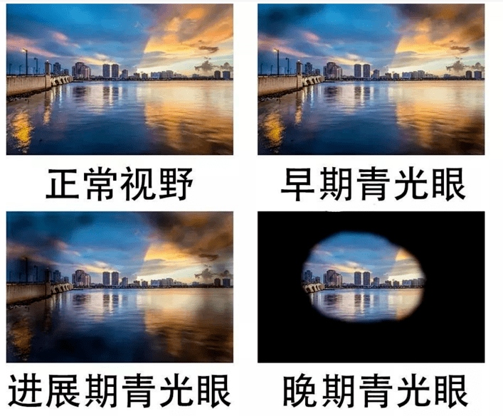 这4个动作，大人小孩经常做，没想到竟成了青光眼的“帮凶”！插图(4)