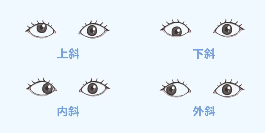 家长请注意：开学在即，这两种儿童眼病“视”关重大！插图