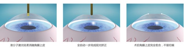 近视度数越高手术价格越贵，是这样吗？插图(2)