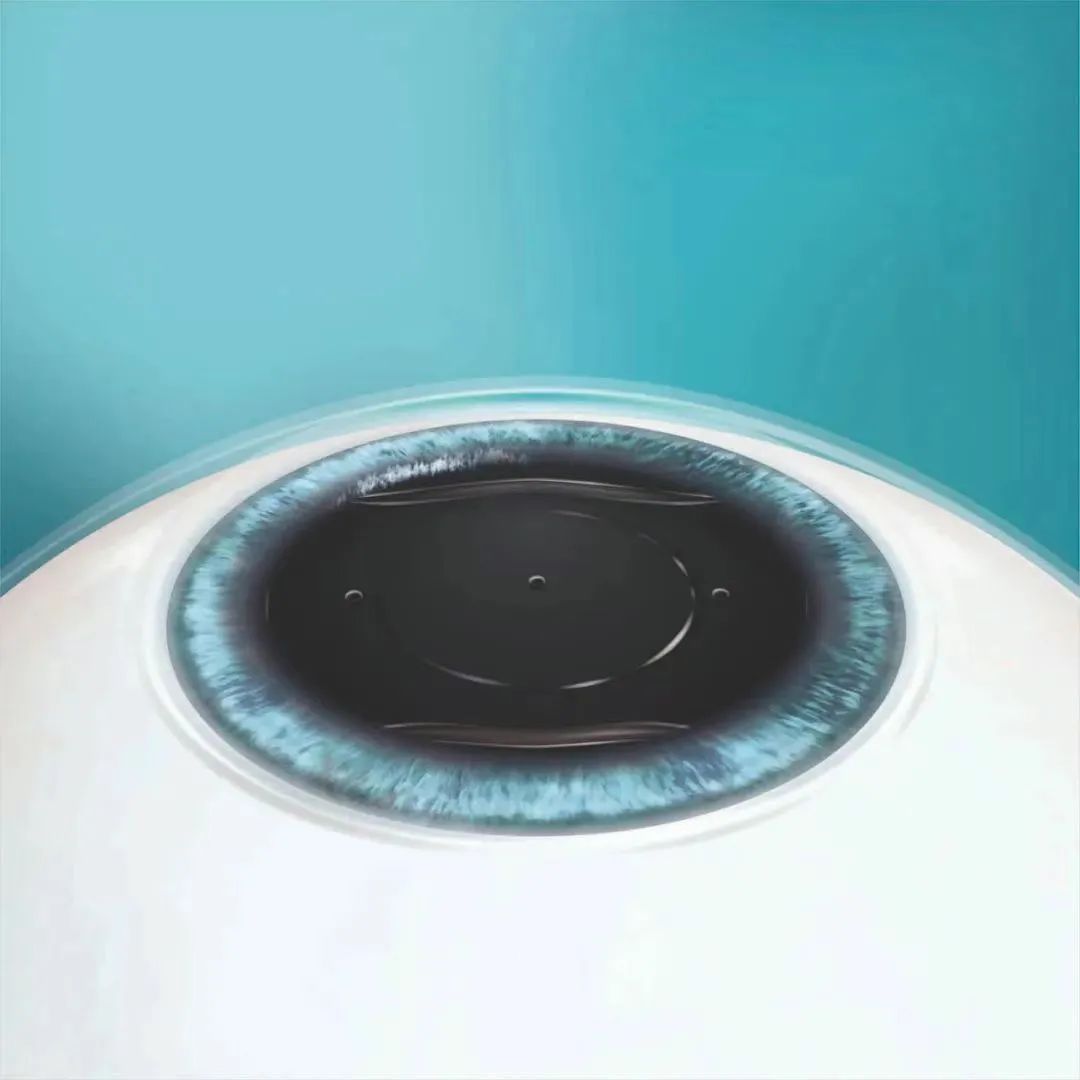 600度以下近视，有没有必要选择ICL晶体植入？插图(1)