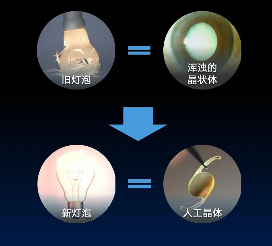 家里老人看不清？得了白内障怎么办？插图(1)