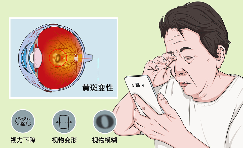 【科普】眼底病变，你了解吗？不要忽视插图