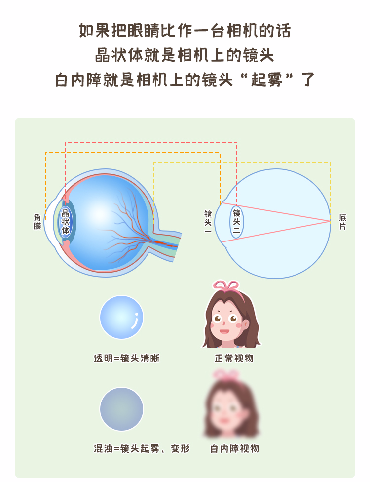 白内障手术也有“黄金季节”？插图(2)