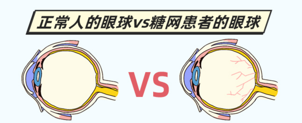 糖尿病患者眼病防控的“小秘方”！插图