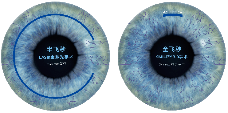 全飞秒手术中忍不住想眨眼，怎么办？插图(2)