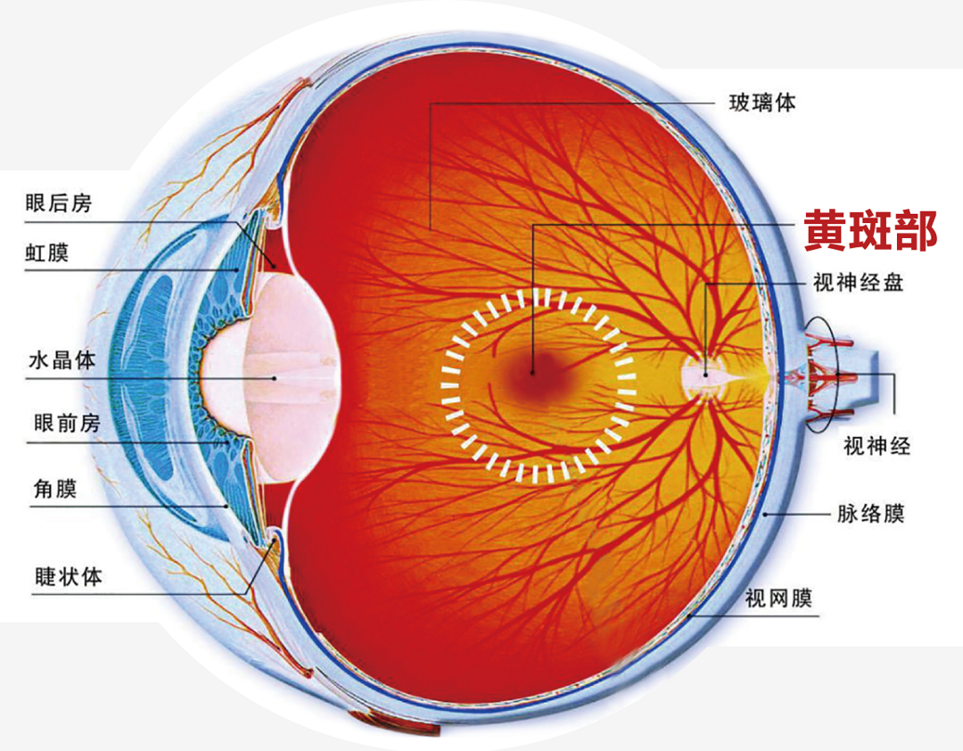 “老花”与黄斑前膜早期相似，但后果可大不一样！插图