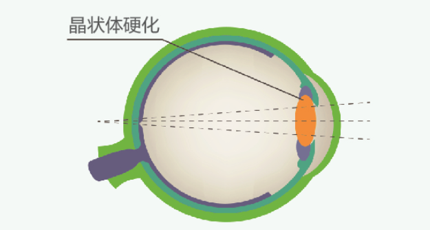 “老花”与黄斑前膜早期相似，但后果可大不一样！插图(1)