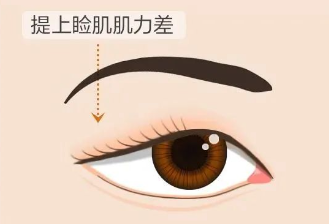 上睑下垂＝眼皮松弛？这篇推文告诉你答案插图