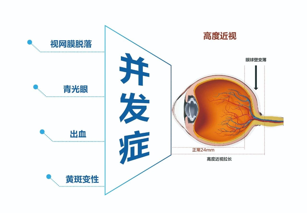 高度近视的危害有哪些？如何预防和矫治？一文给你讲清楚插图(2)
