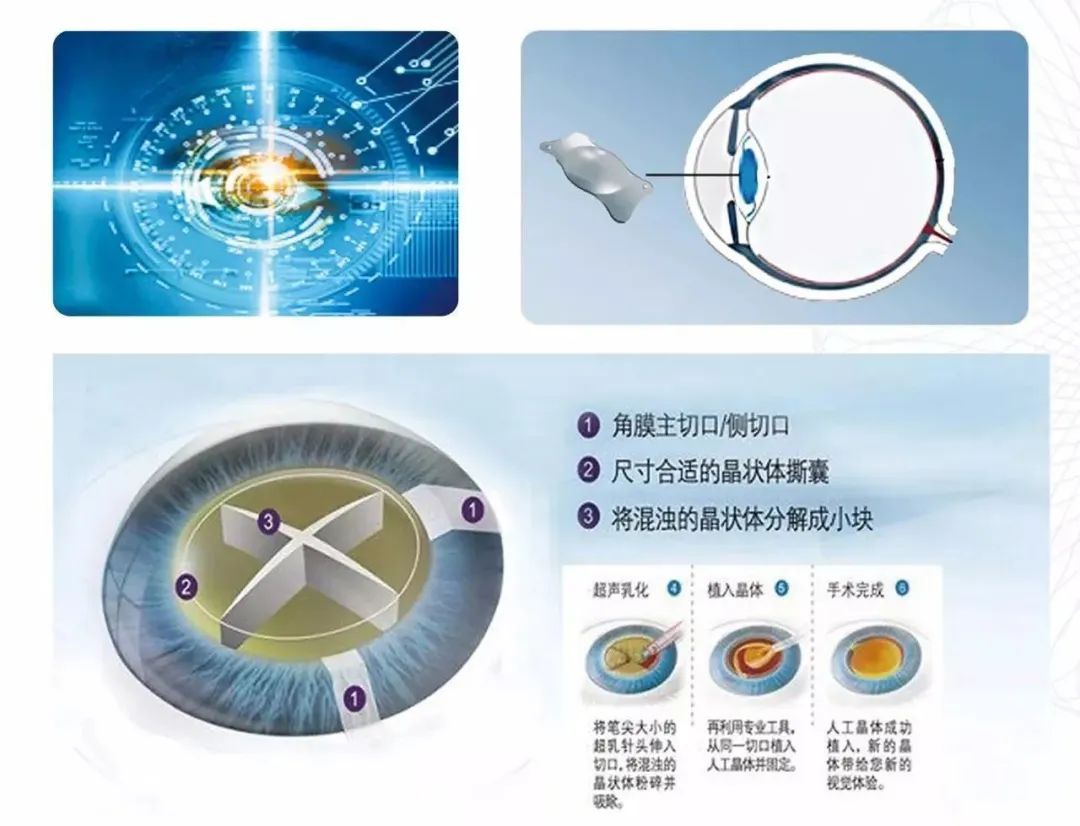 飞秒白内障手术和飞秒近视手术有哪些区别？这2点教你读懂！插图