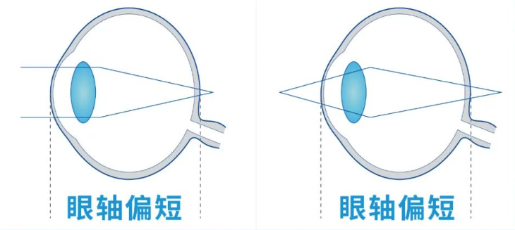 【科普】正确区分远视和老花！插图