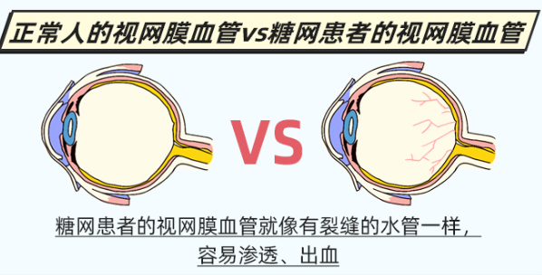 眼底检查能发现什么？到底有没有必要？插图(1)