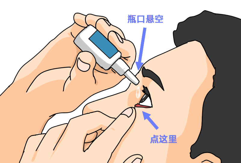 白内障术前术后为什么要滴眼药水？插图(2)
