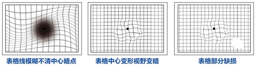关于黄斑病变，你真的了解吗？插图(1)