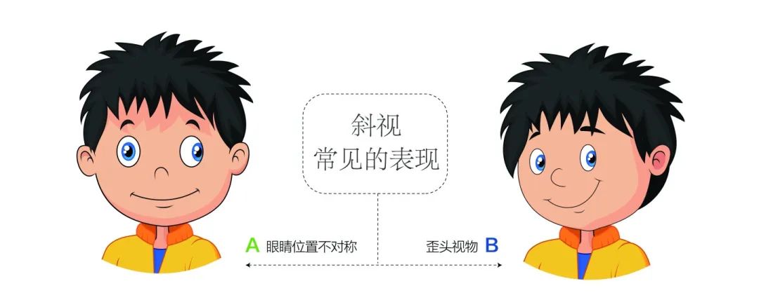 斜视的危害千万不是小事！插图(2)