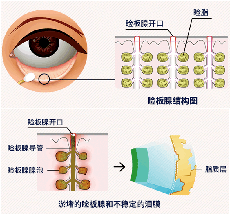 为什么早上刚睡醒就感觉眼睛干涩？插图