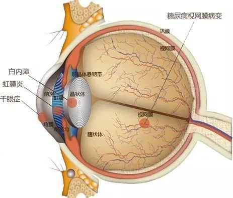 明明我在控制血糖，为什么眼睛还是出问题了？插图(1)
