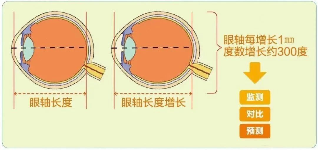 不想近视度数越来越深,这个方法真心建议试试!插图 不想近视度数越来越深,这个方法真心建议试试!插图