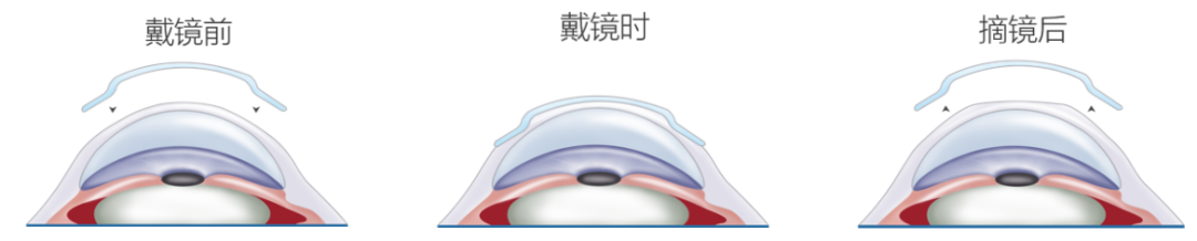 不想近视度数越来越深,这个方法真心建议试试!插图(1) 不想近视度数越来越深,这个方法真心建议试试!插图(1)