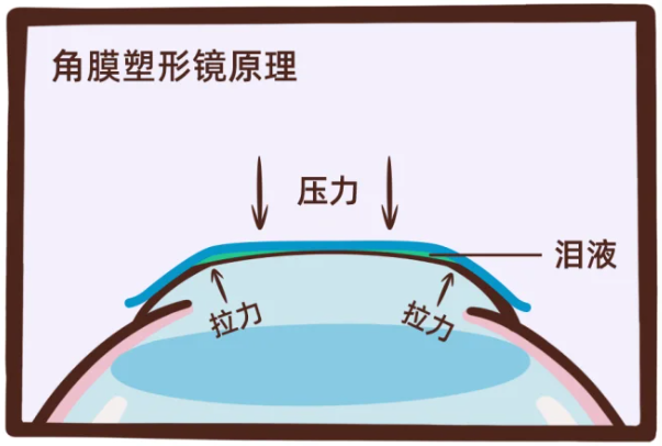 不想近视度数越来越深,这个方法真心建议试试!插图(2) 不想近视度数越来越深,这个方法真心建议试试!插图(2)
