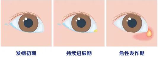 【科普】婴幼儿泪囊炎该如何对待？插图(1)