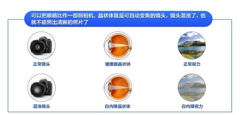 “道听途说”被误导？关于白内障的这些“坑”不要踩！插图