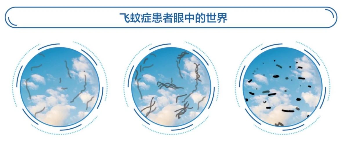 眼前总有“蚊子”在飞，这个病越来越多年轻人中招插图