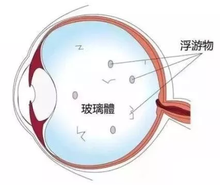 眼前总有“蚊子”在飞，这个病越来越多年轻人中招插图(1)