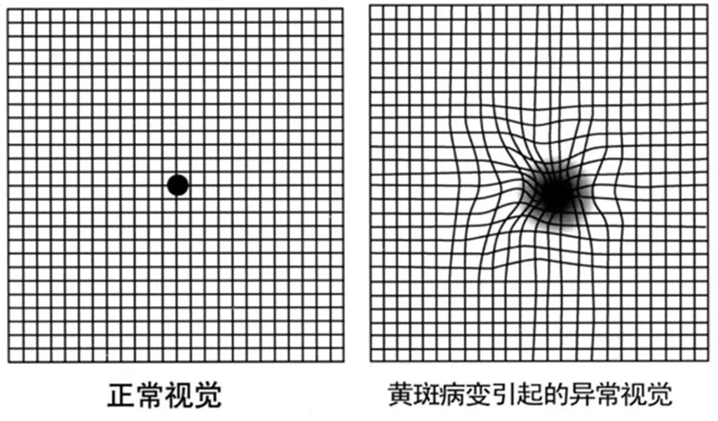 为什么视物会发生扭转？黄斑出了问题！插图(2)