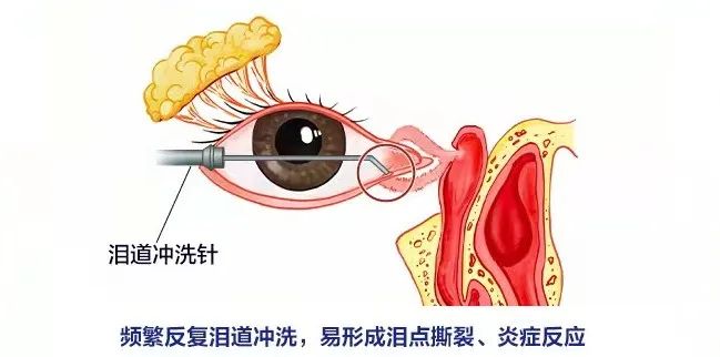 起床眼屎多？注意了！它既伤眼又影响外貌！插图(2)