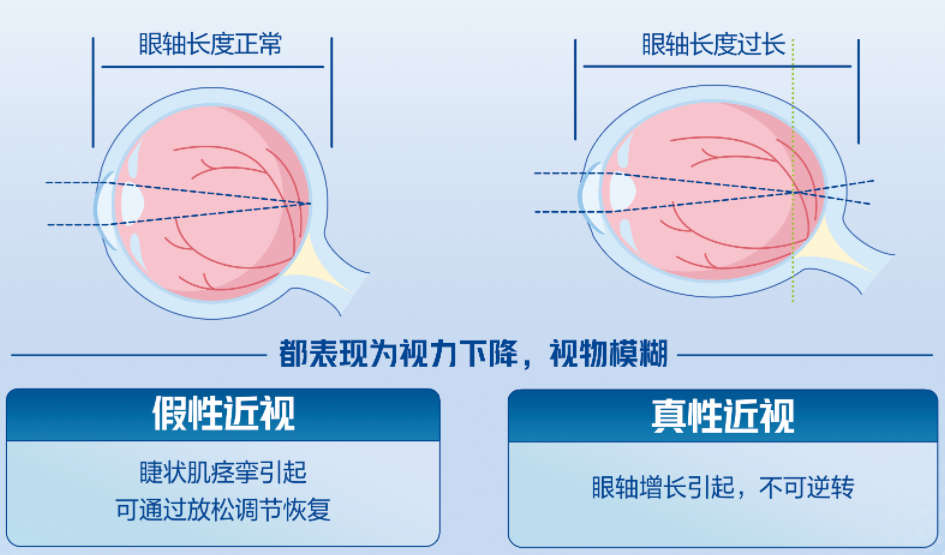 @所有家长，近视管理“四查”都是什么？插图(1)
