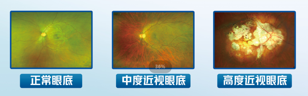 @所有家长，近视管理“四查”都是什么？插图(3)