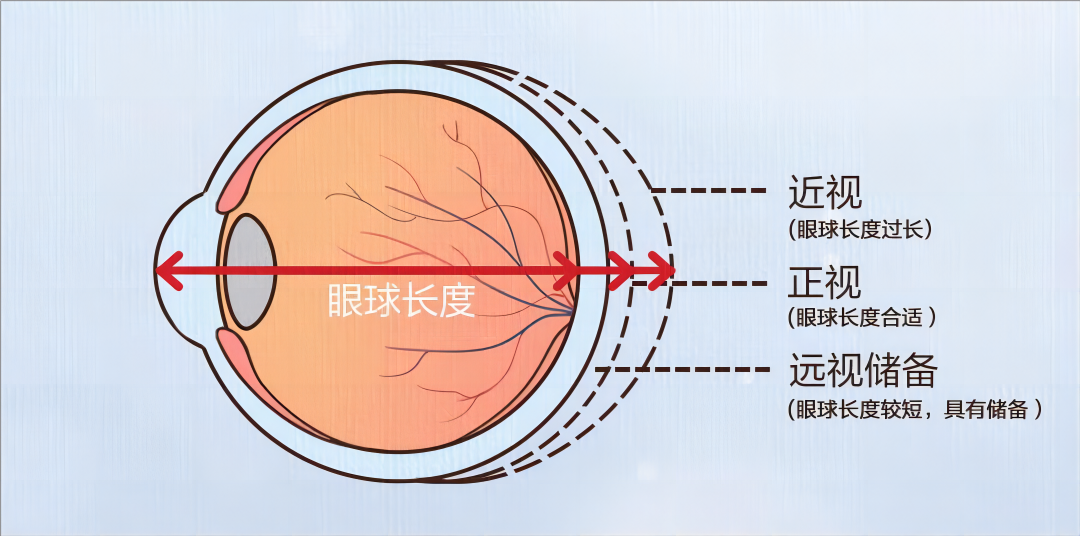 网传近视眼800度降到100度的方法，可信吗？插图(1)