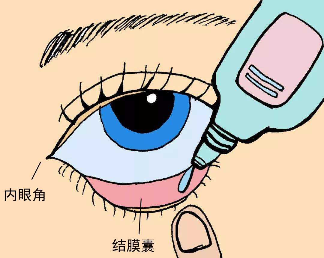 眼药水不要滴在黑眼珠上，还有这些坑也不能踩!插图