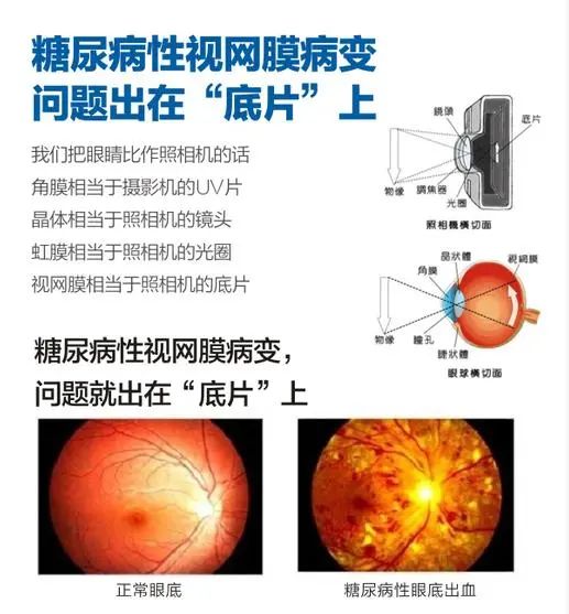 “糖网”是个什么网？糖尿病人为何脱离不了眼病的威胁？插图(1)